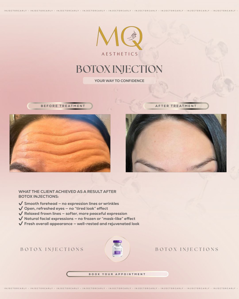 Xeomin Injections