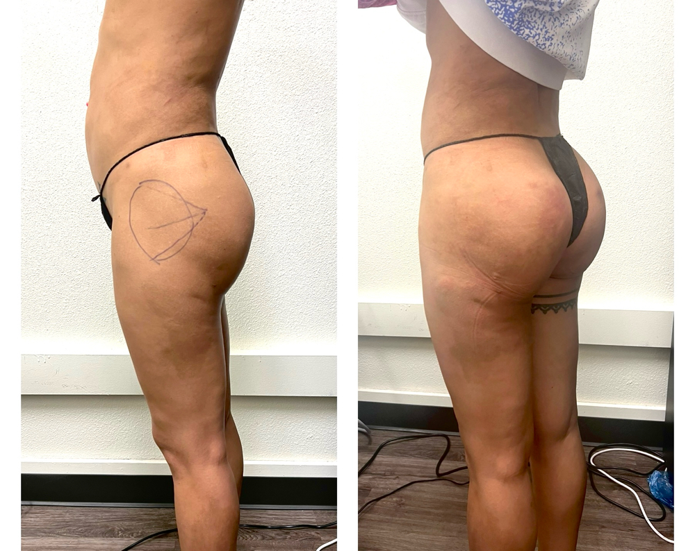 6-Sculptre Butt Lift package