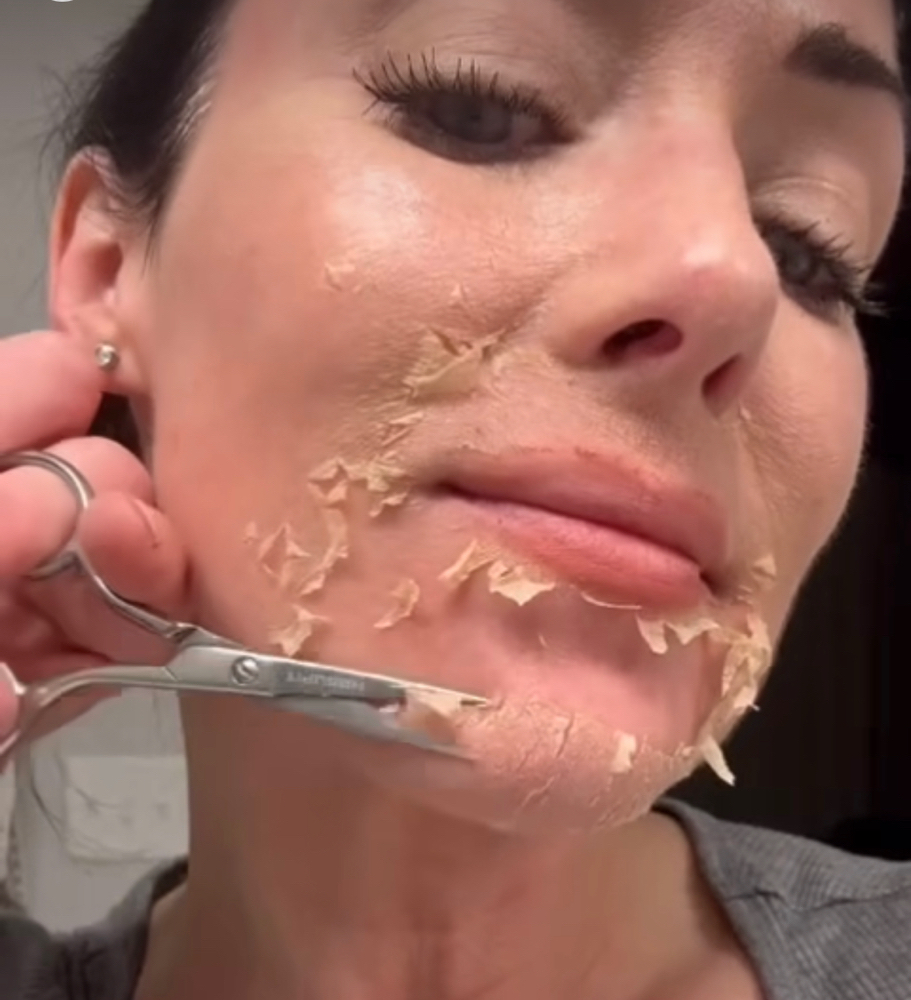 The Perfect Derma Peel