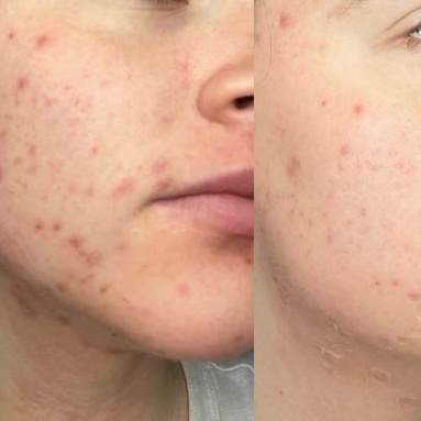 Adolescent Facial at the glowfairy spa in framingham, MA