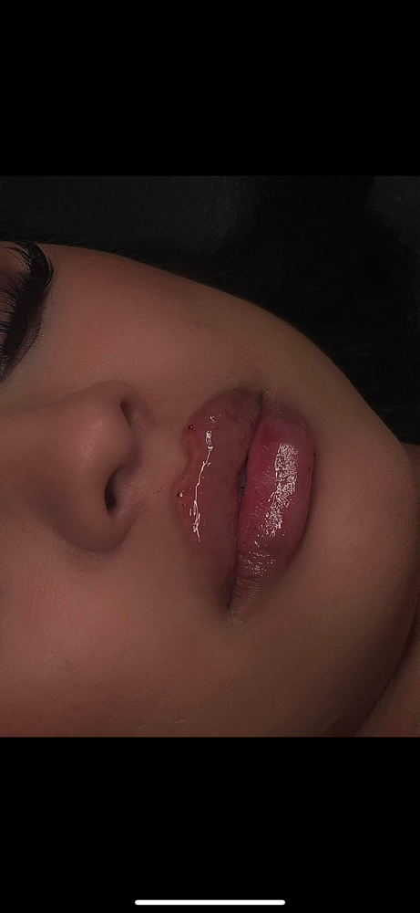 Full Syringe (1ml) + GFE
