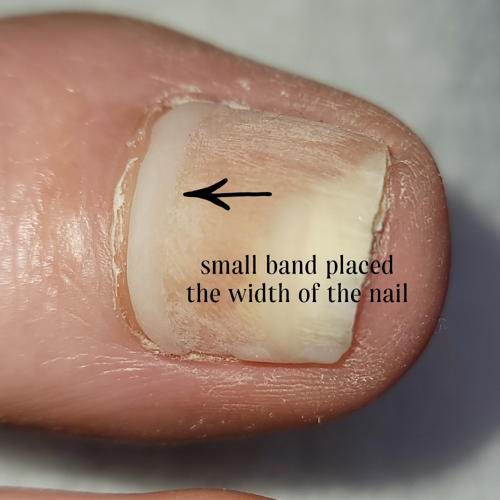 Onyfix Toenail Correction