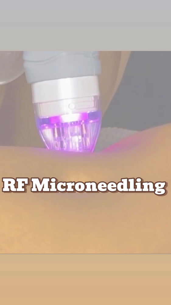 RF Micro-needling for Skin