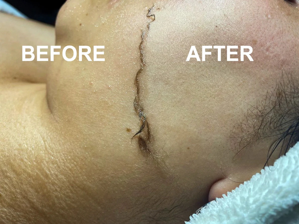 Fuzz Off Facial