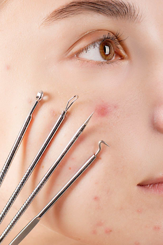Acne Clearing Facial