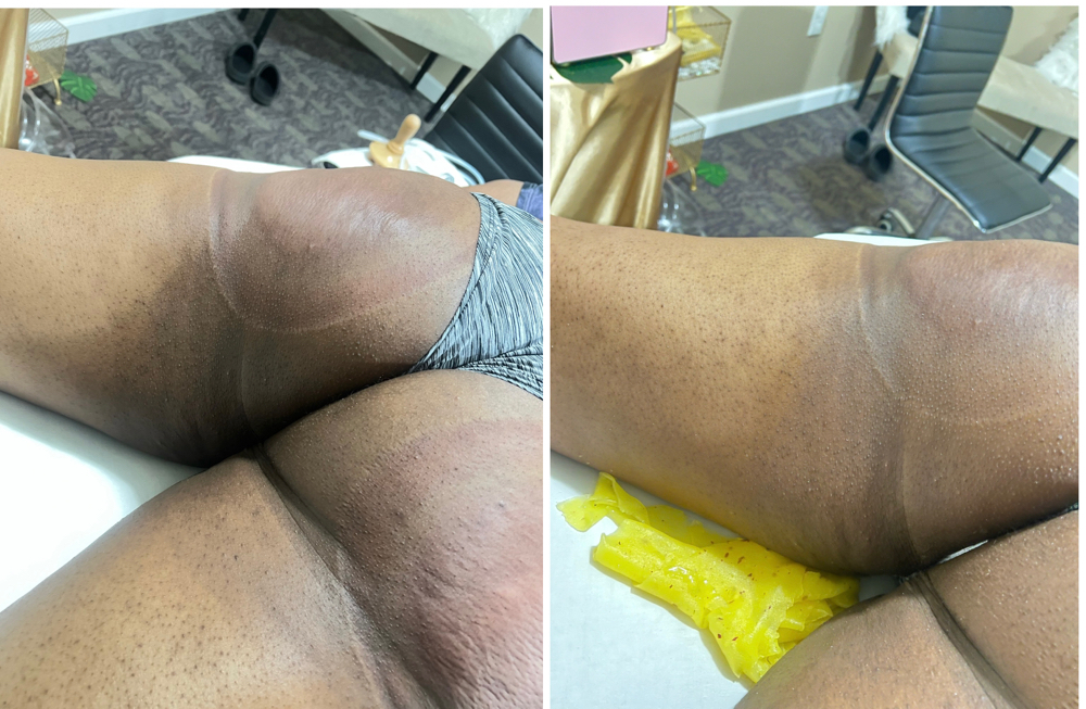 Hyperpigmentation session at ๐ข๐ฑ๐ฎ๐๐ต๐ฒ๐ท๐๐ in Charlotte, NC