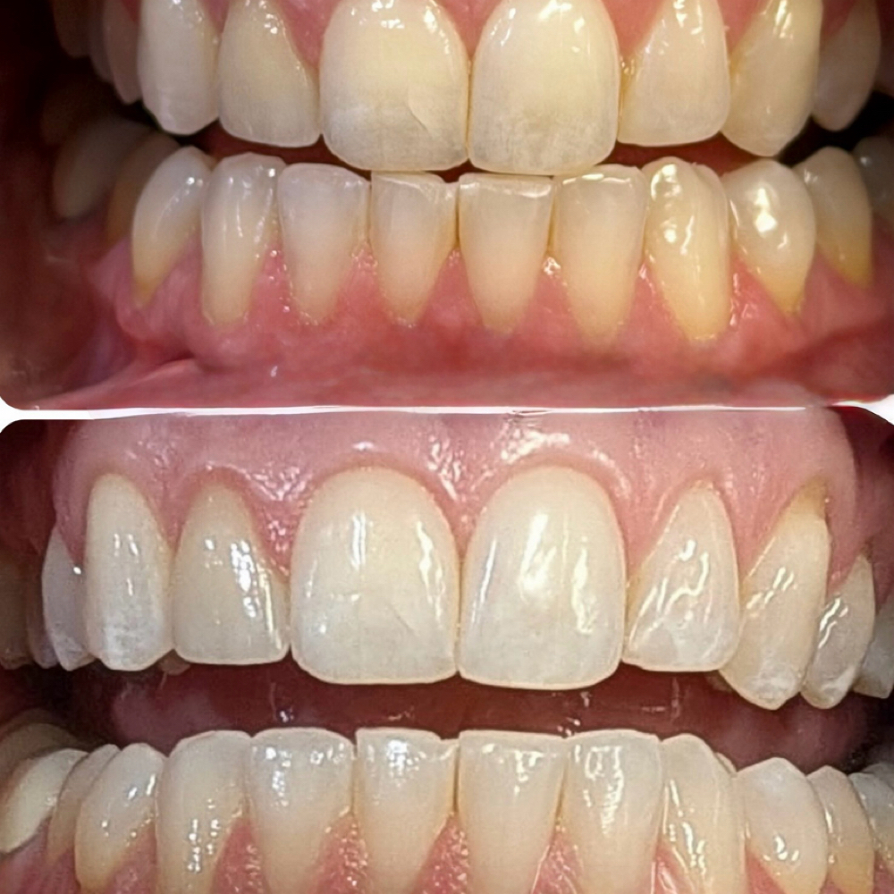 Teeth Whitening at Lisa’s Lil Spa Room in Sioux Falls, SD