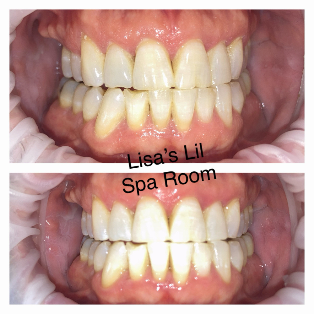 Teeth Whitening at Lisa’s Lil Spa Room in Sioux Falls, SD