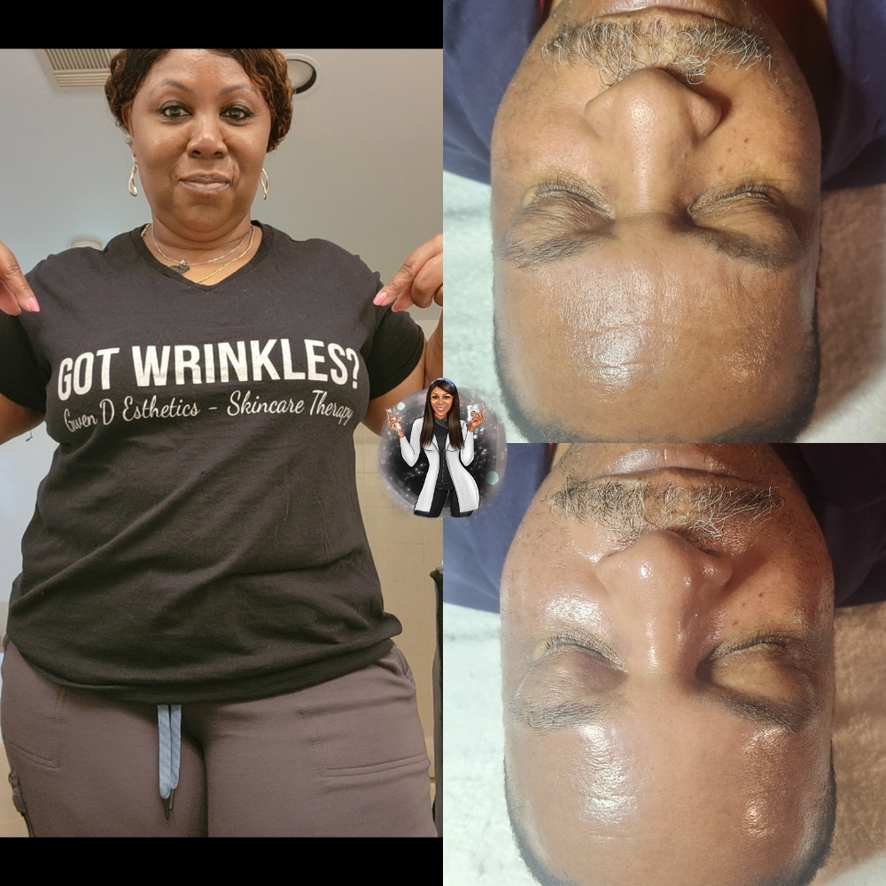 Hyaluronic Acid Infusion at Gwen D Esthetics in Lanham, MD