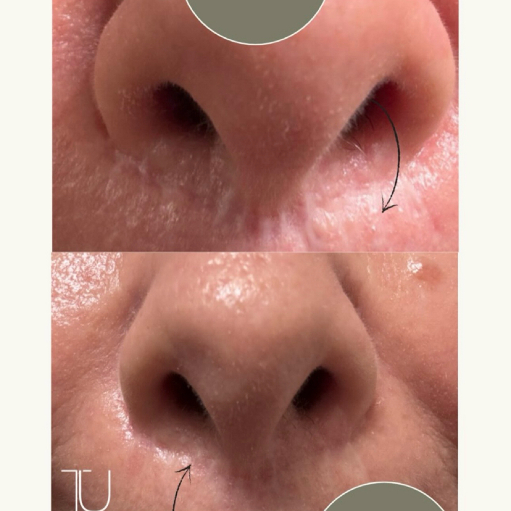 💎 CO₂ Texture Refinement Series at Tru U Esthetix in Franklin, TN