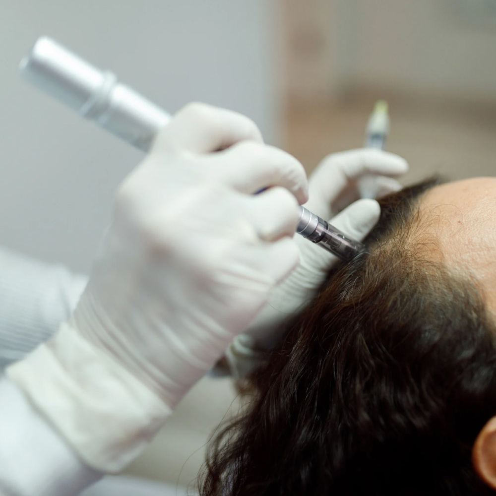 MICRONEEDLING MESOTHERAPY TREATMENT