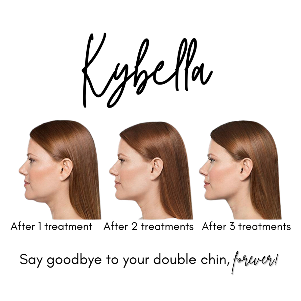 Kybella- Permanent Faf Reduction at Injections by Leighanna in Clarksville, IN