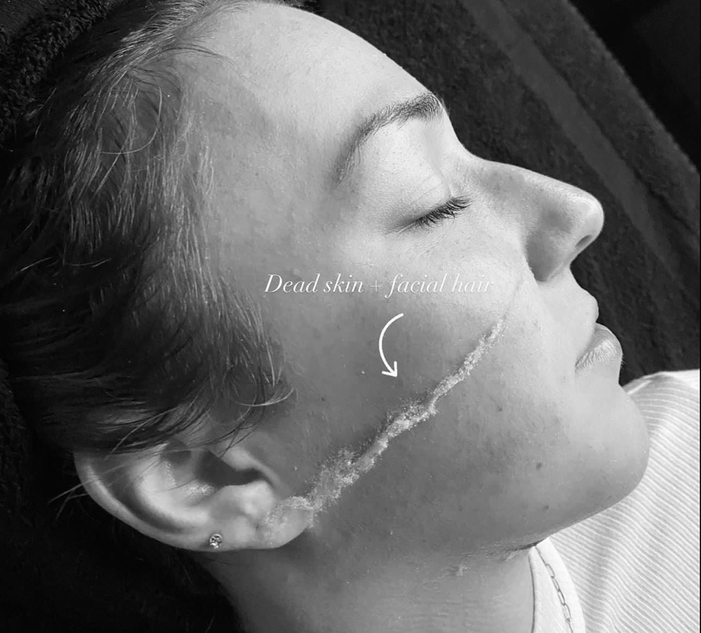 Dermaplane Facial