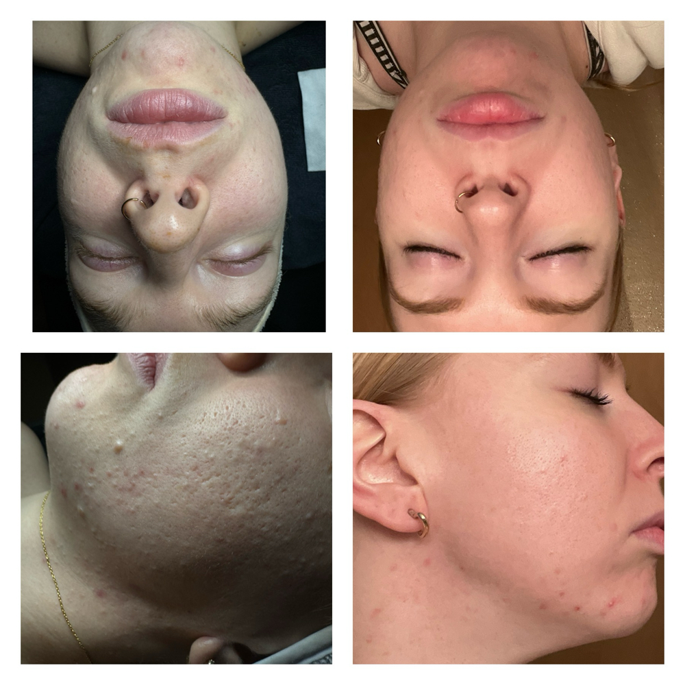 Chemical Peel Facial