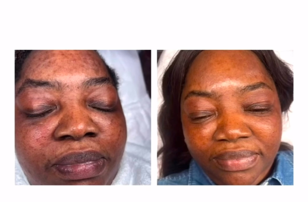 4 Moderate Hyperpigment Treatment at Houston Skin Treatment in Houston, TX