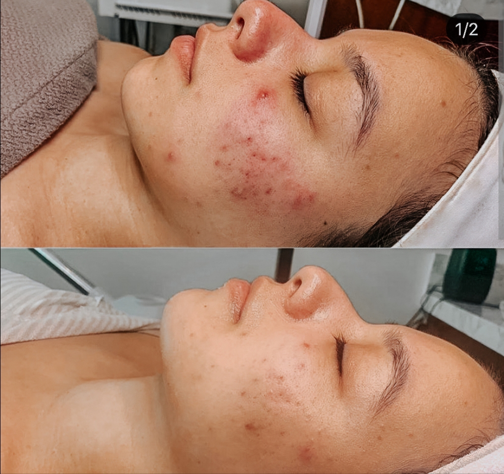 Circadia RX Acne And Rosacea Facial