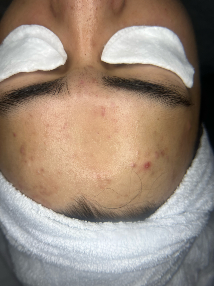 Acne Facial