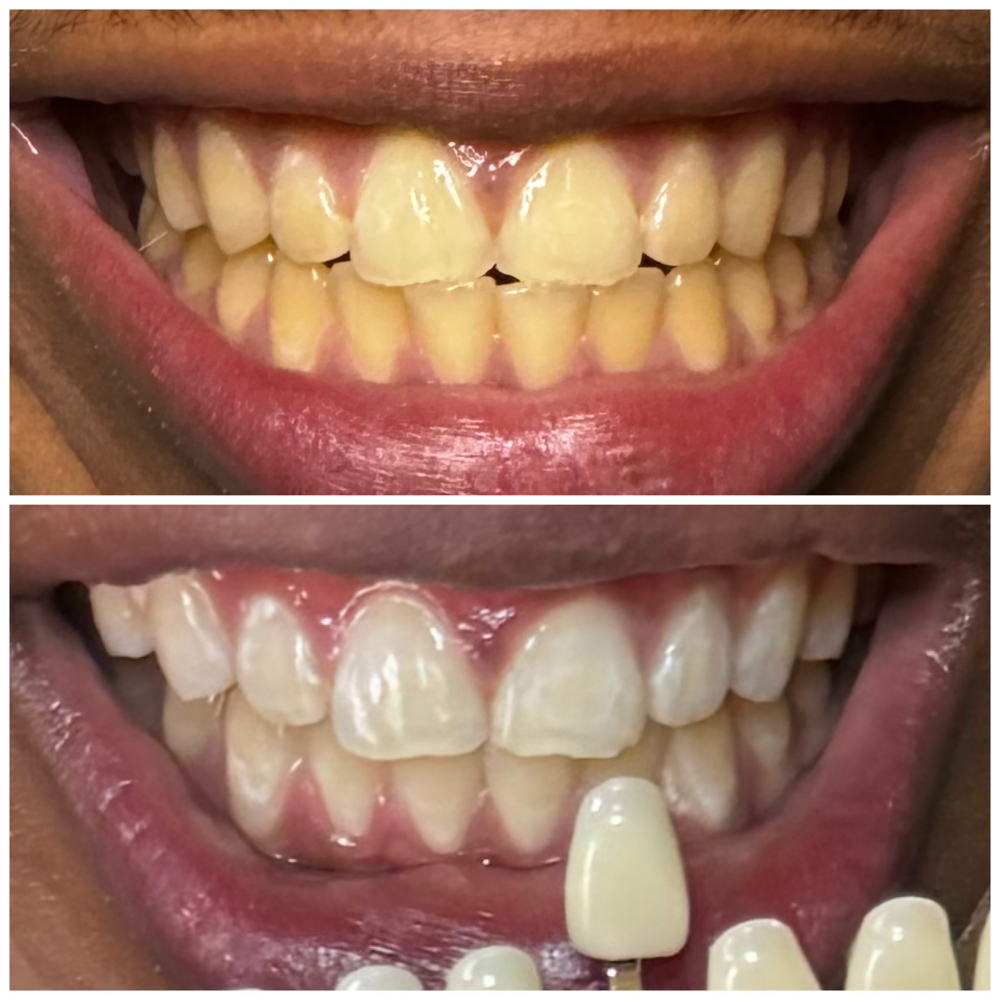 ADVANCE WHITENING at Island Pro Smiles Mobile Teeth Whitening in Sandwich, MA