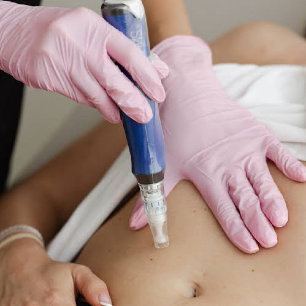 MICRONEEDLING TREATMENT at Luscious Curves Beauty in Las Vegas, NV