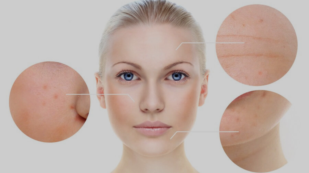 Chemical Peel ( Peeling Quimico)