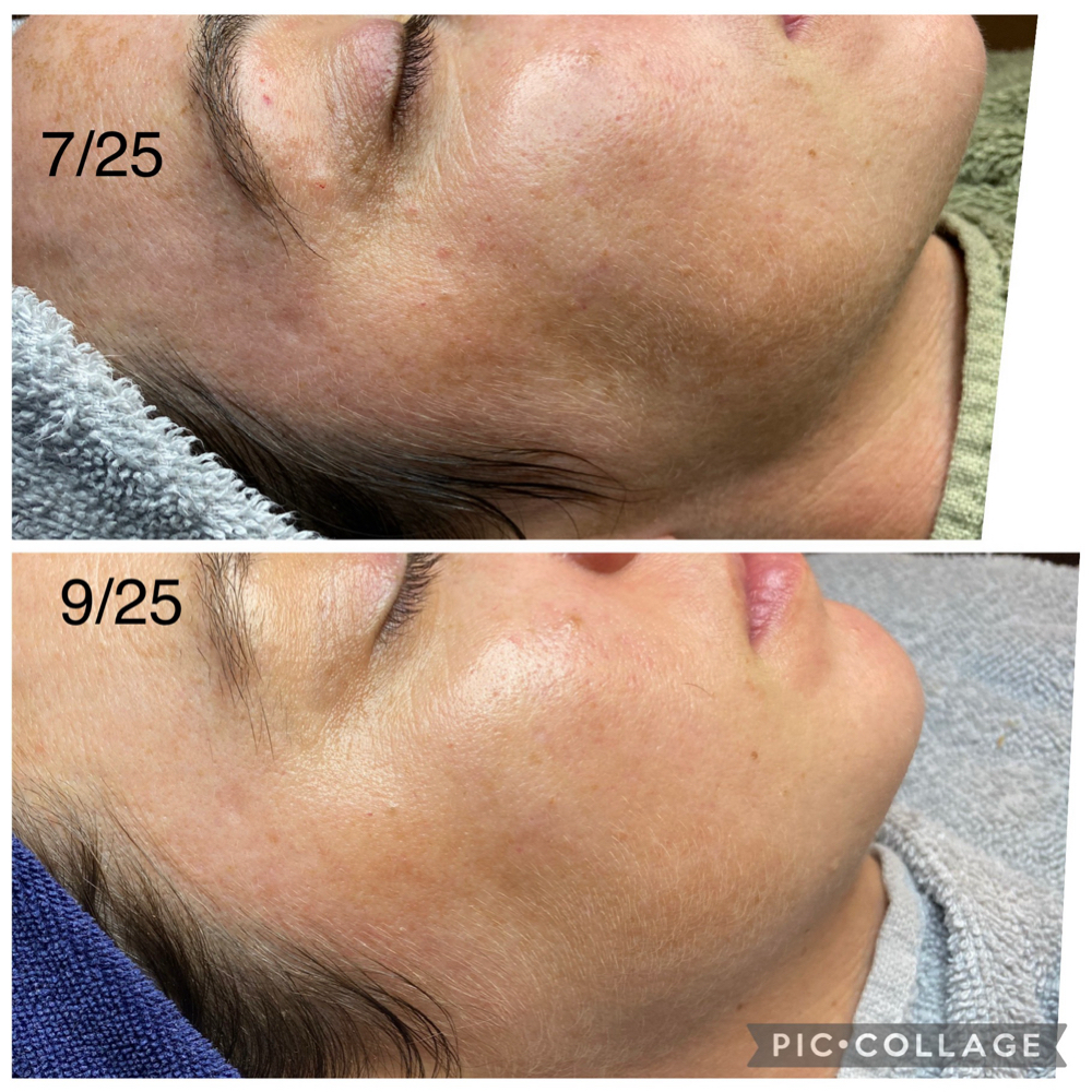 PRX Peel 4 treatment series at MOON Organics & Esthetics in Decatur, GA