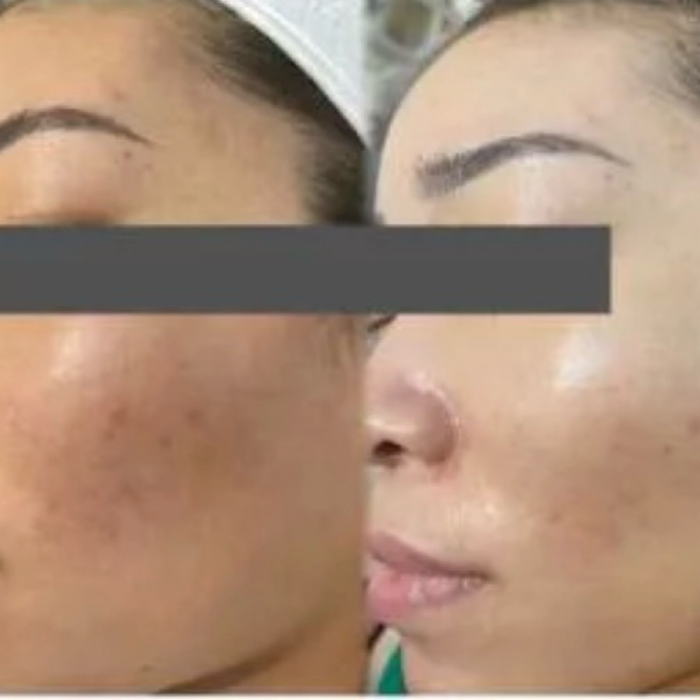 Exosomes Skin at Josephs Rejuvenation Center in Snellville, GA
