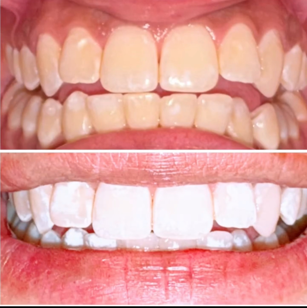 30 Minute Whitening Session