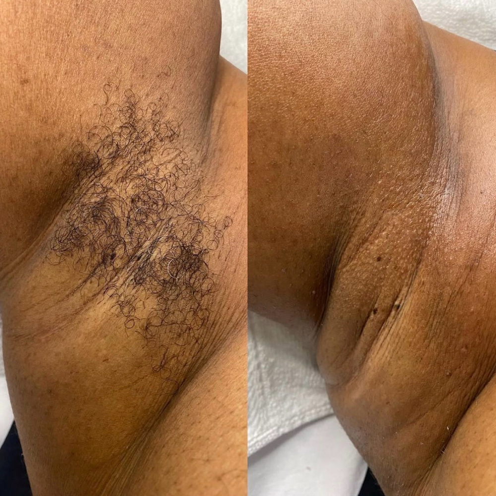 Underarm Wax at EstheticsHD in Naples, FL