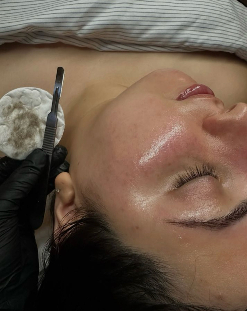 Dermaplaning Treatment
