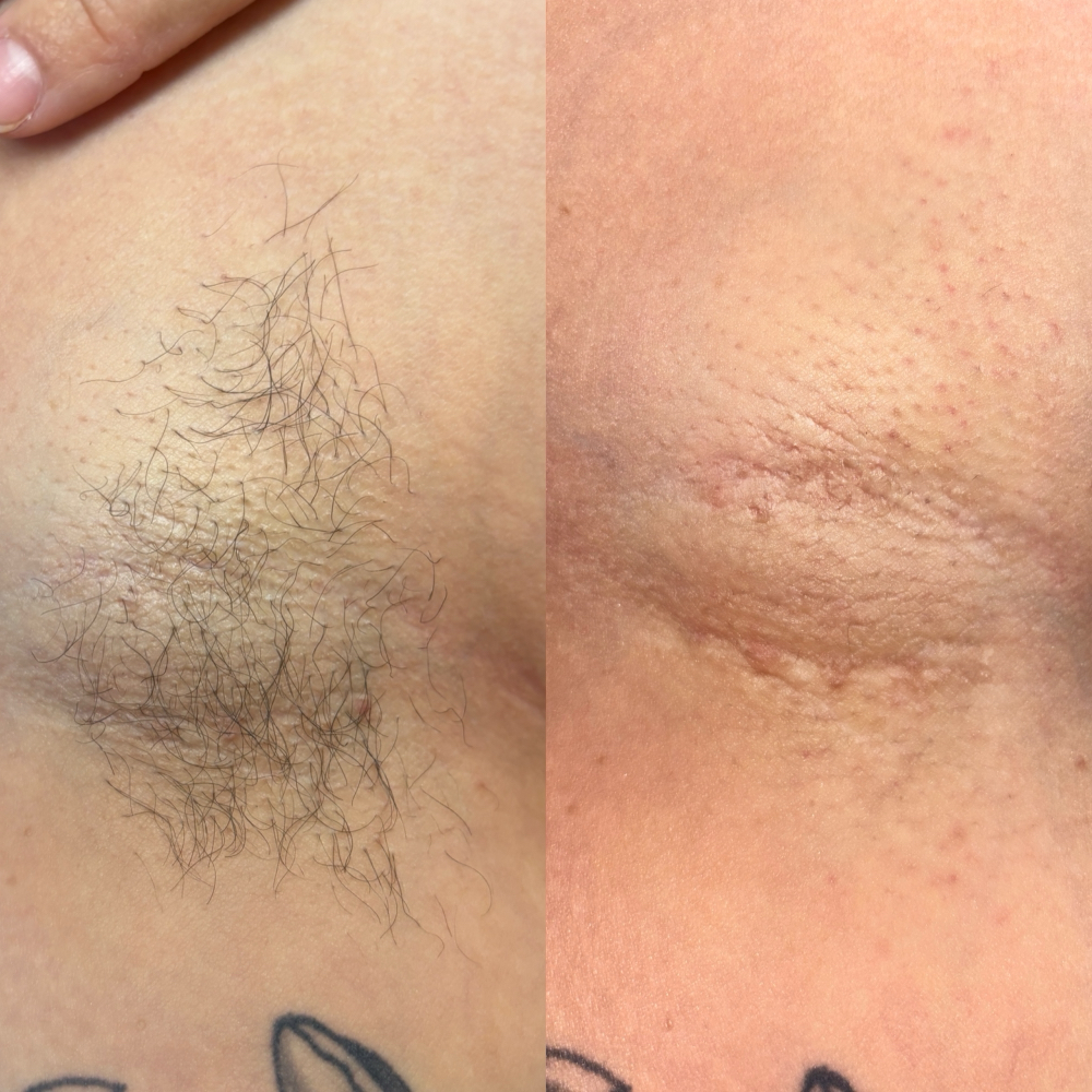 Underarm Wax