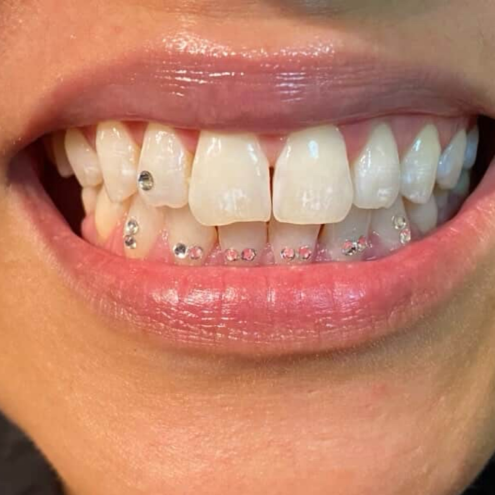 Tooth Gems at NBN Chicago in Chicago, IL