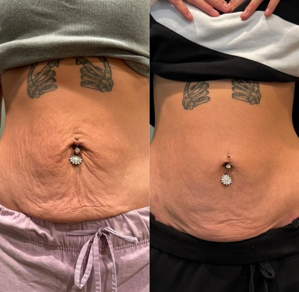Skin Tightening Treatment Series