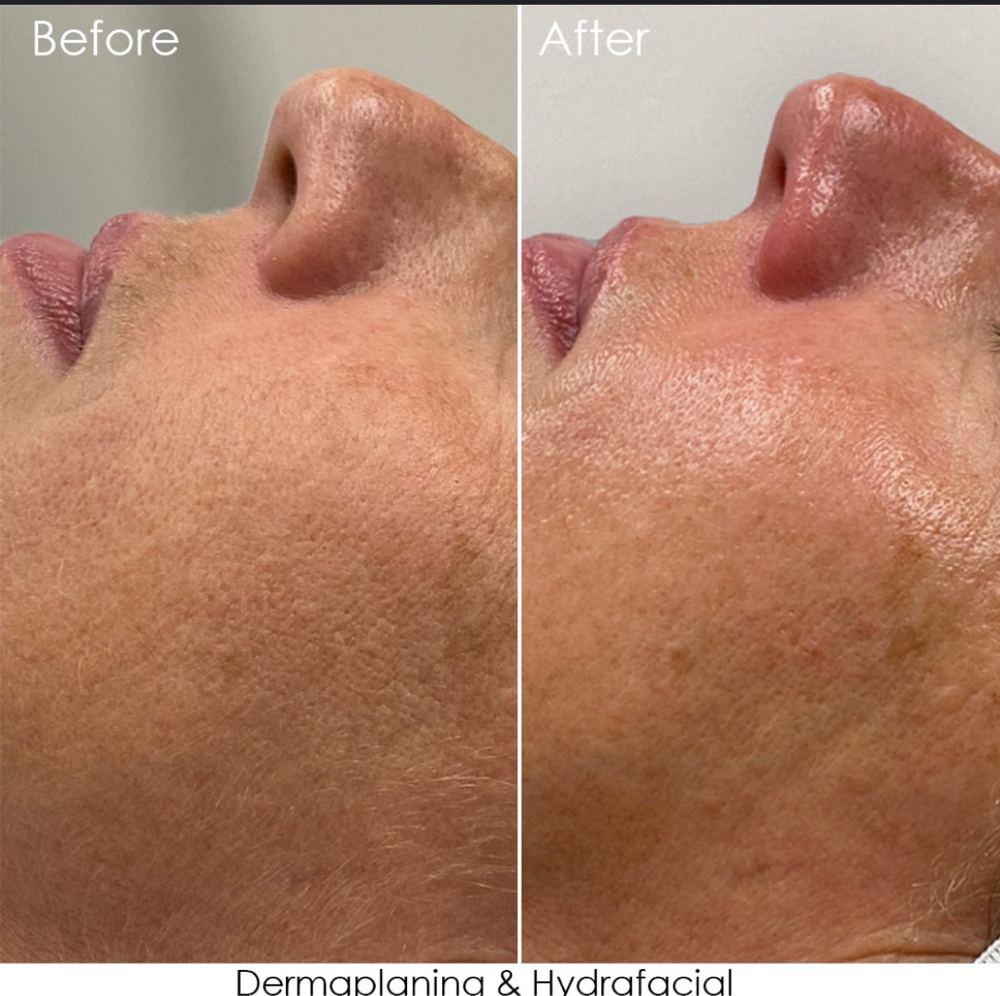 Anti-Aging Facial at Ultimate Skin Care in Flanders, NJ