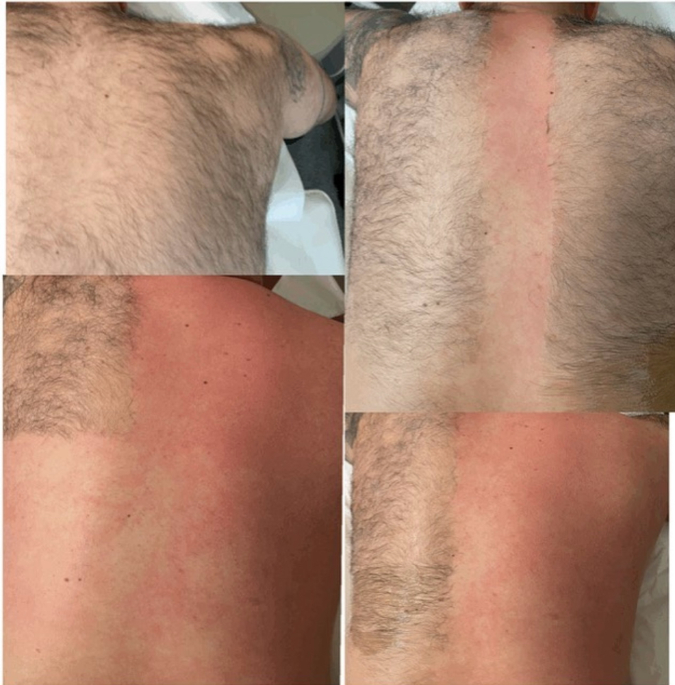 Back waxing/ Depilación Espalda