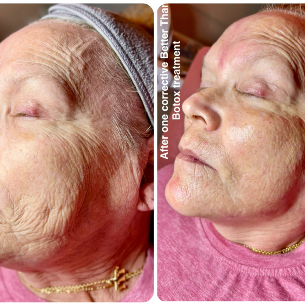 Better Than Botox Facial at Star Esthetics By Maicey Tankersley in Annville, KY