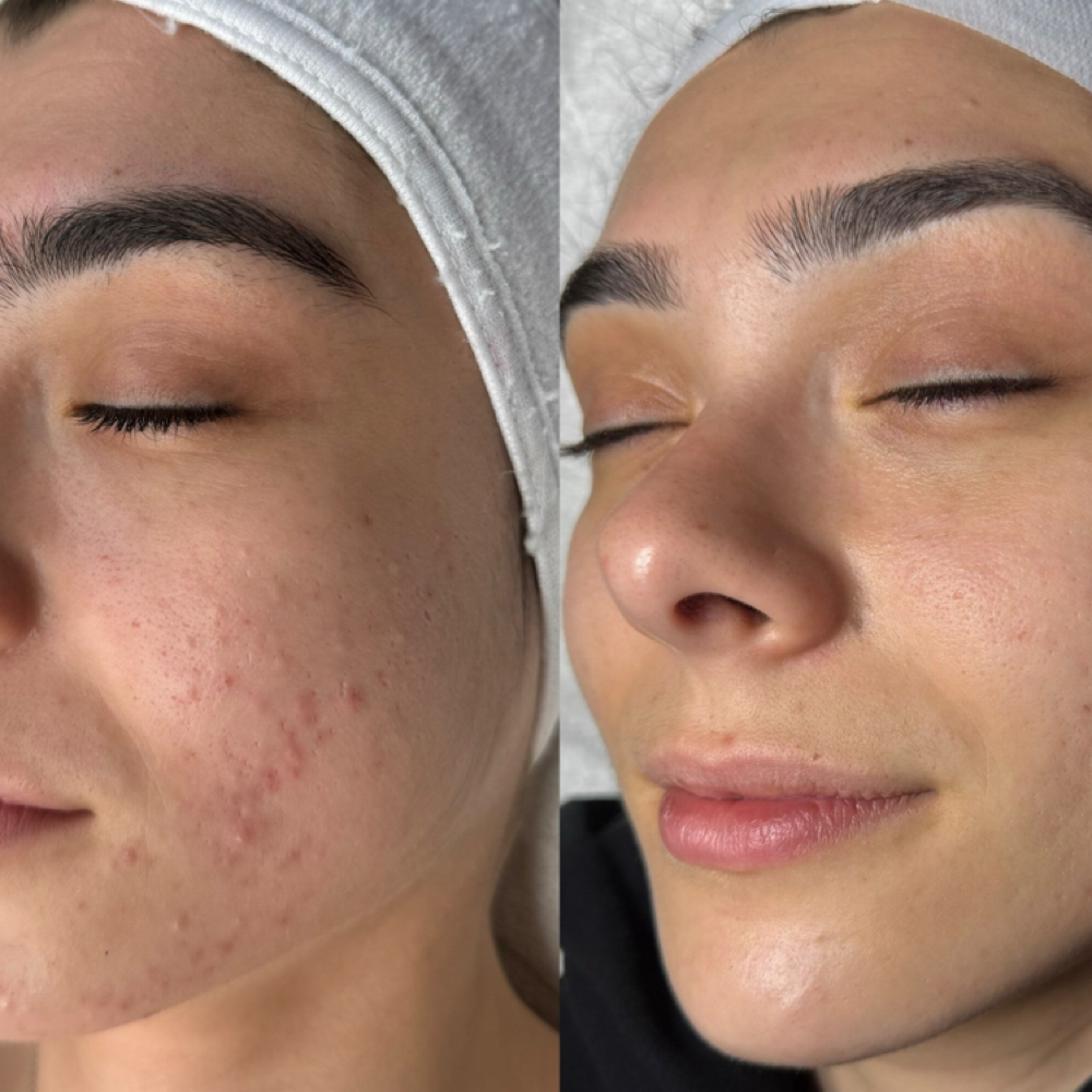 VI Peel + Peptides at Oasiah Aesthetics in New York, NY