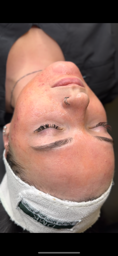 Acne Facial