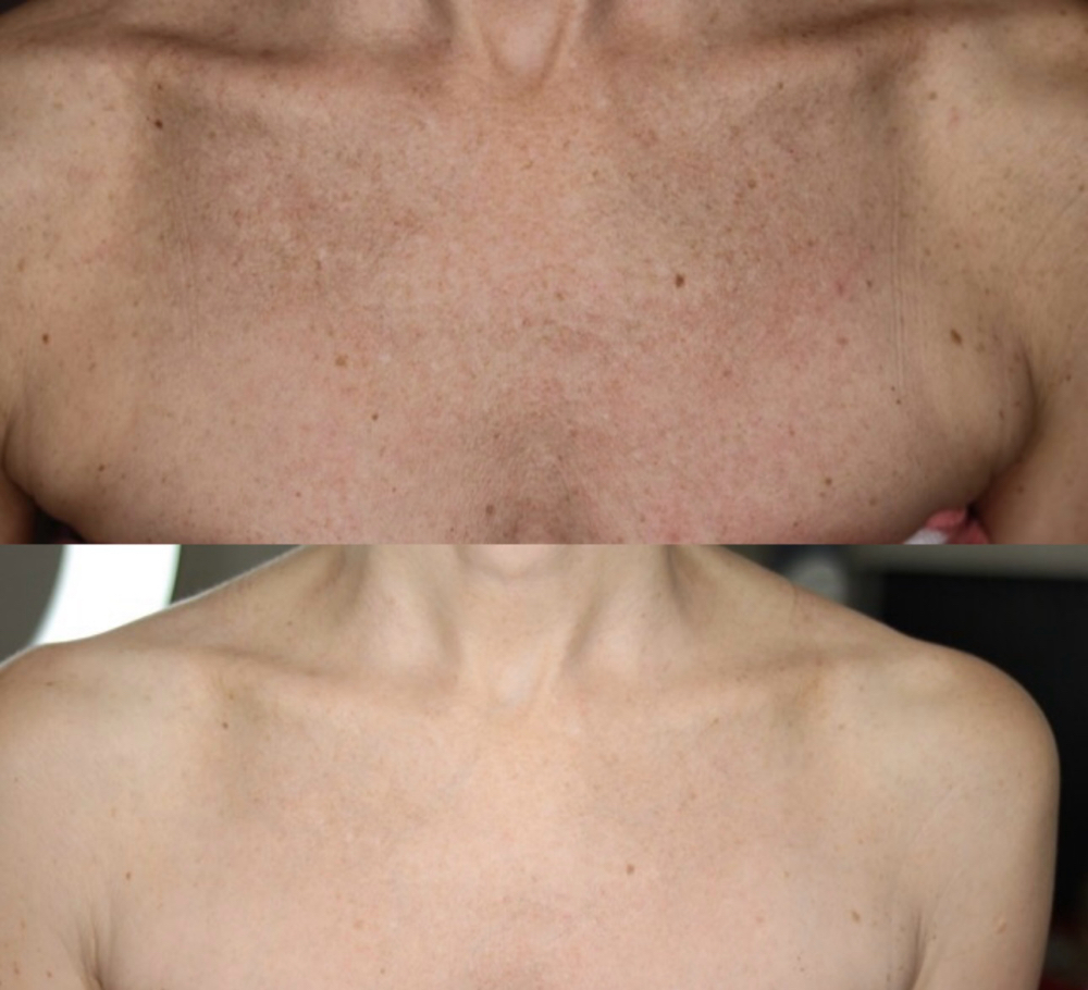 💎 Chest Rejuvenation Microneedling