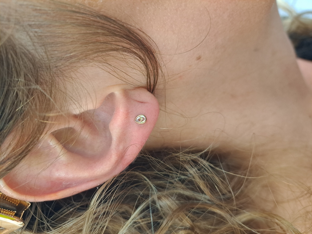 Single Lobe Placement