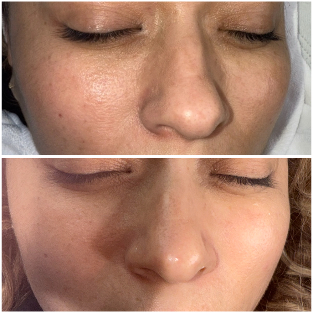 Radiant Age Rewind Facial