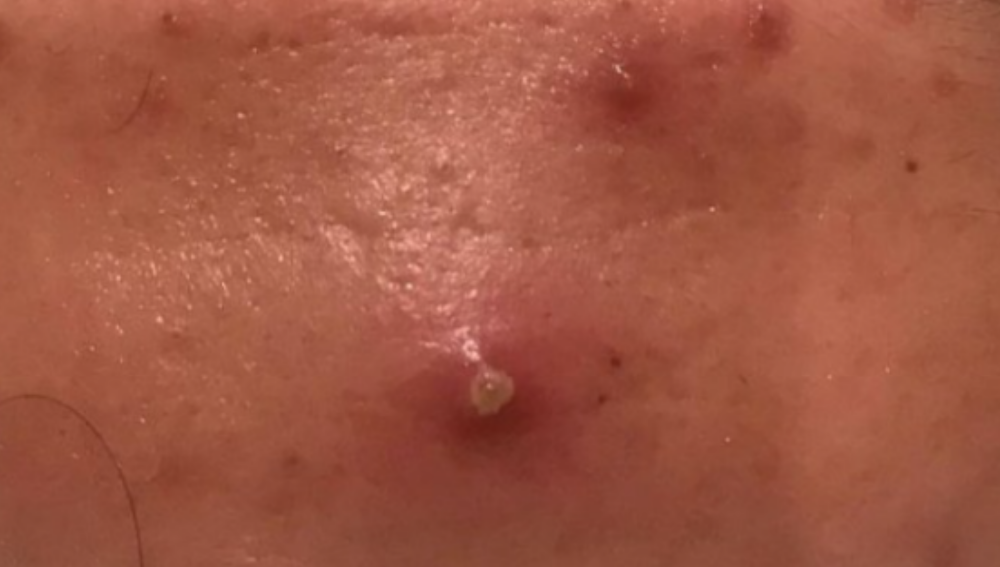 Extractions w/High Frequency Add On