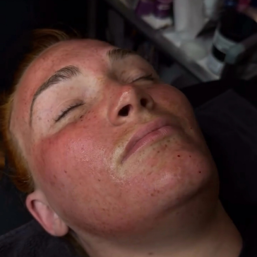 Vampire Facial + Red Light + Lymph at Bliss Med Spa in Riverside, IL