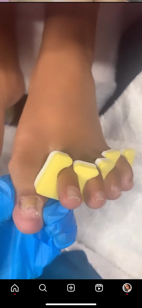 Toe Reconstruction Big Toes Only