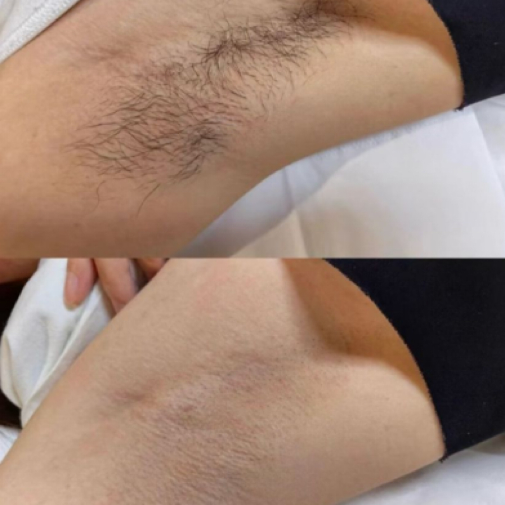 underarm wax at Madi Coca Aesthetics At The Skin Refinery in Nicholasville, KY