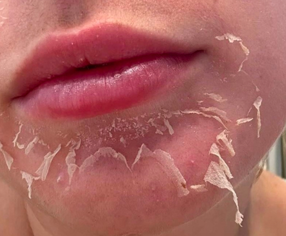 VI Peel Face|Body