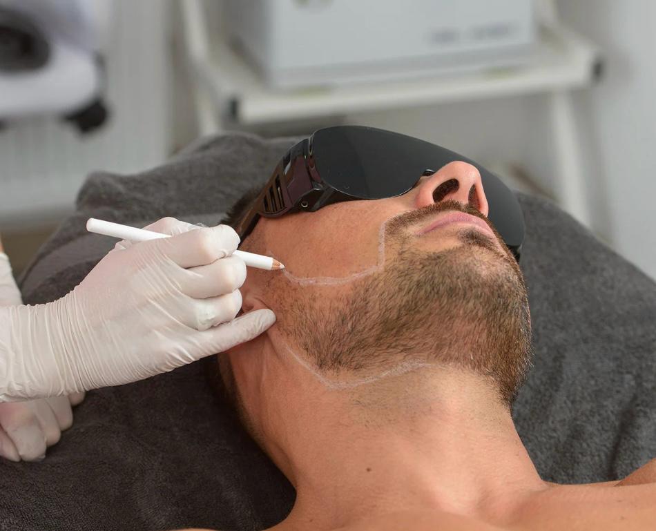 Beard Shaping -Laser Hair Removal