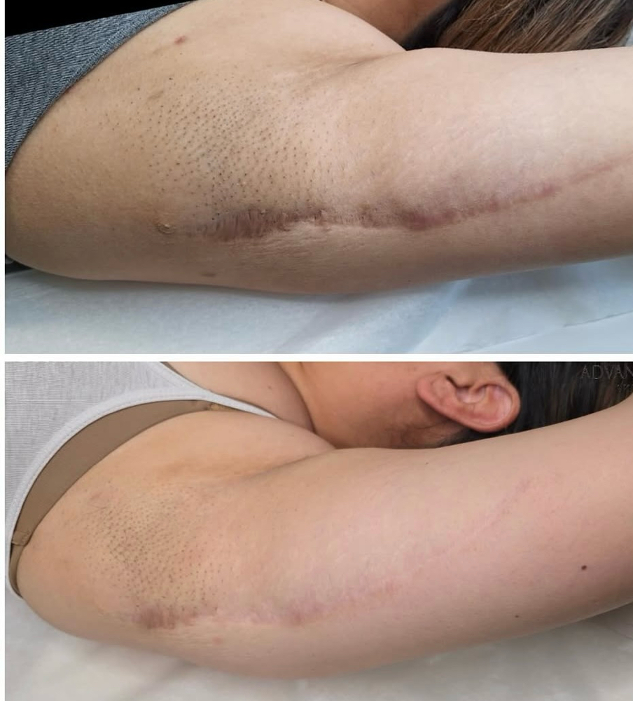 Inkless Scar Revision