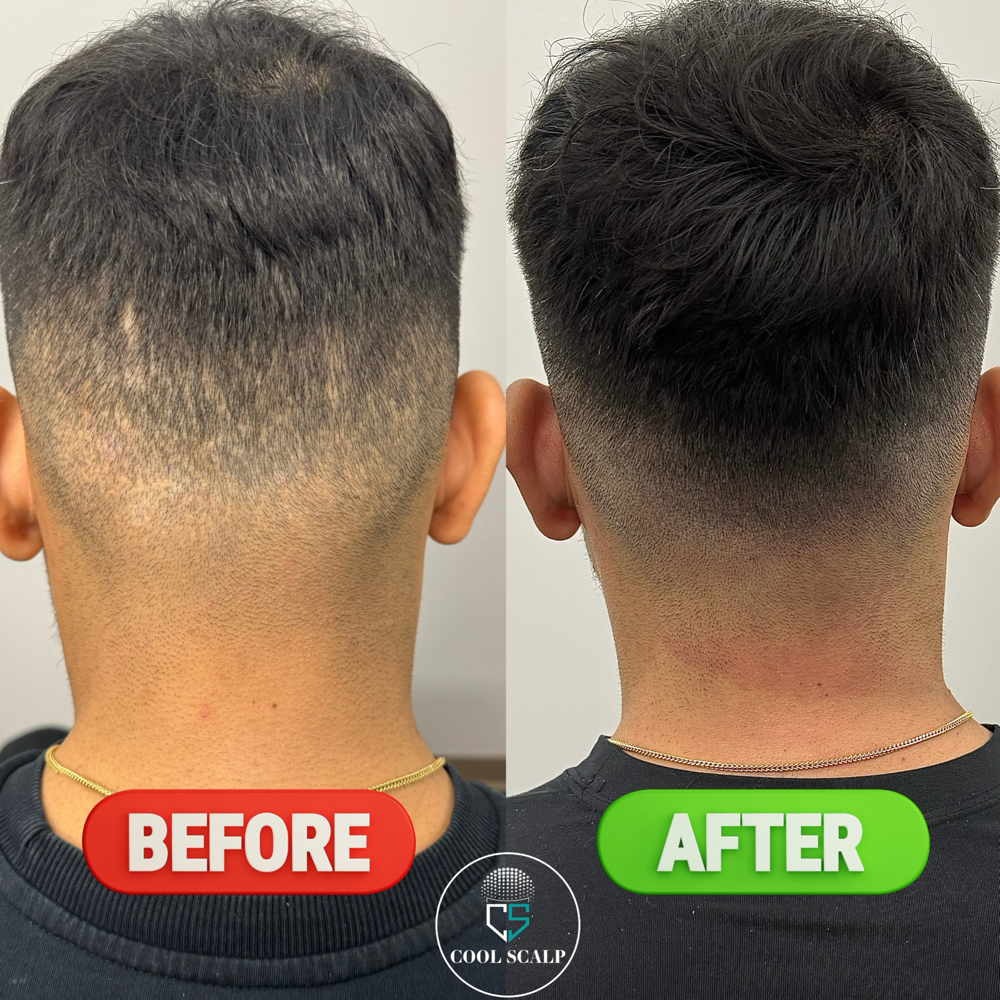 Scalp Micropigmentation Scar Camouflage