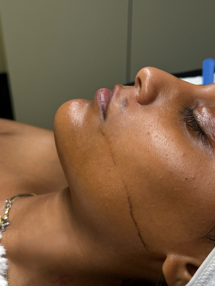 Dermaplane Facial