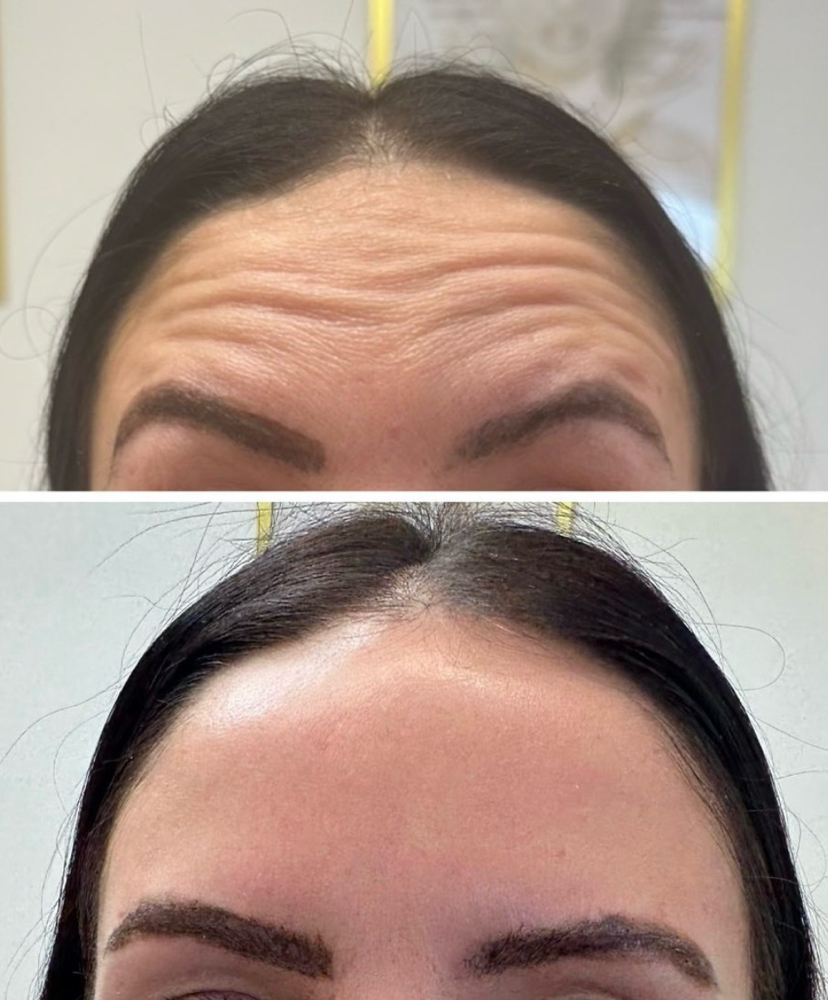 Baby Botox